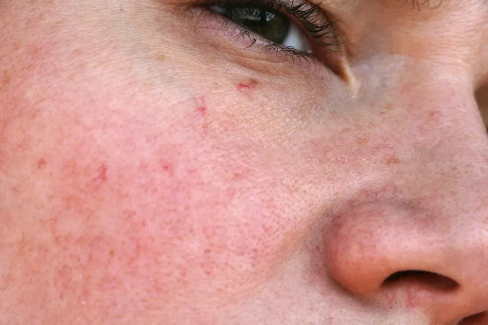 Vasculaze: Get Rid of Embarrassing Spider Veins 